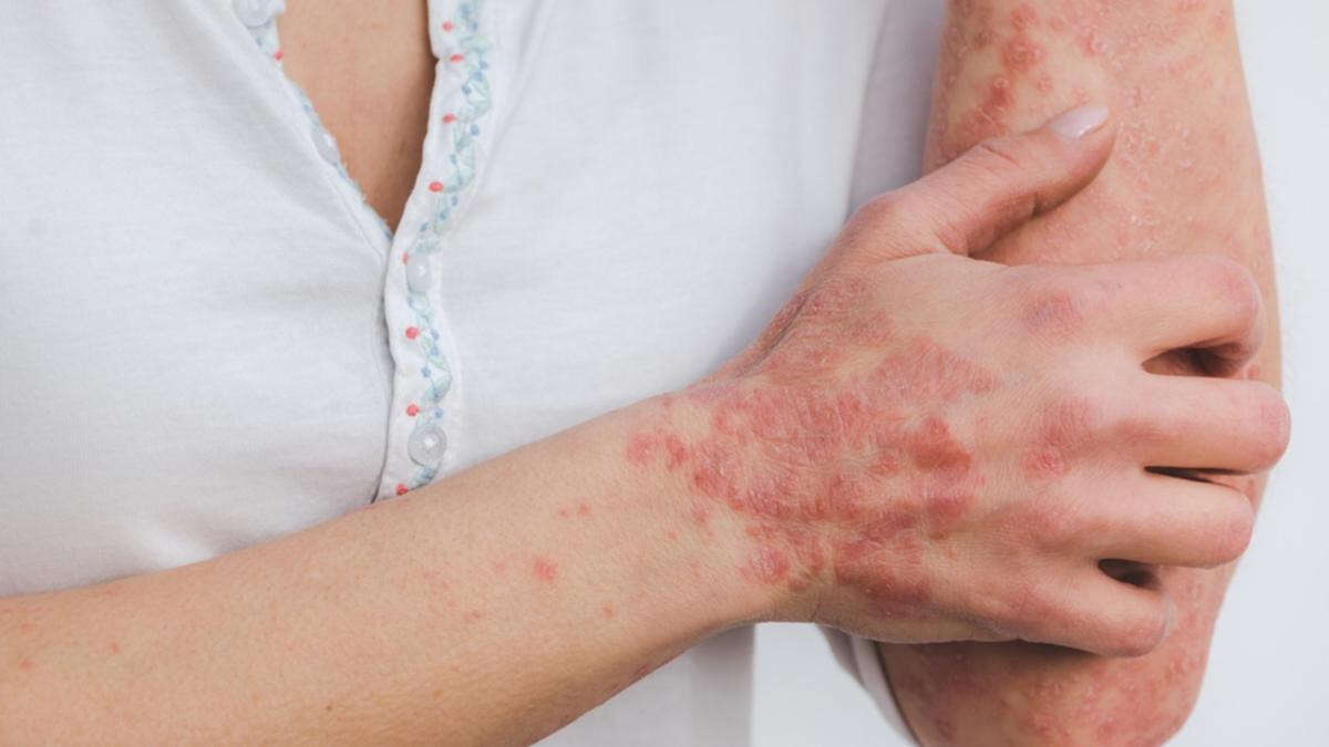 The surprising way you can treat your psoriasis