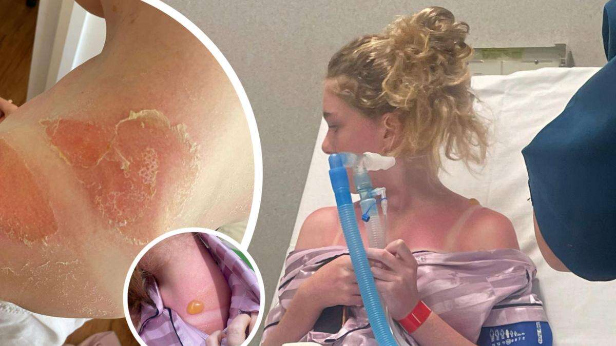 WA kids face alarming rate of severe sunburn cases