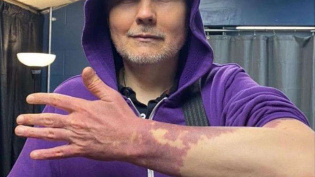 Billy Corgan embraces 'port wine' birthmark he's tried to hide his 'whole life'