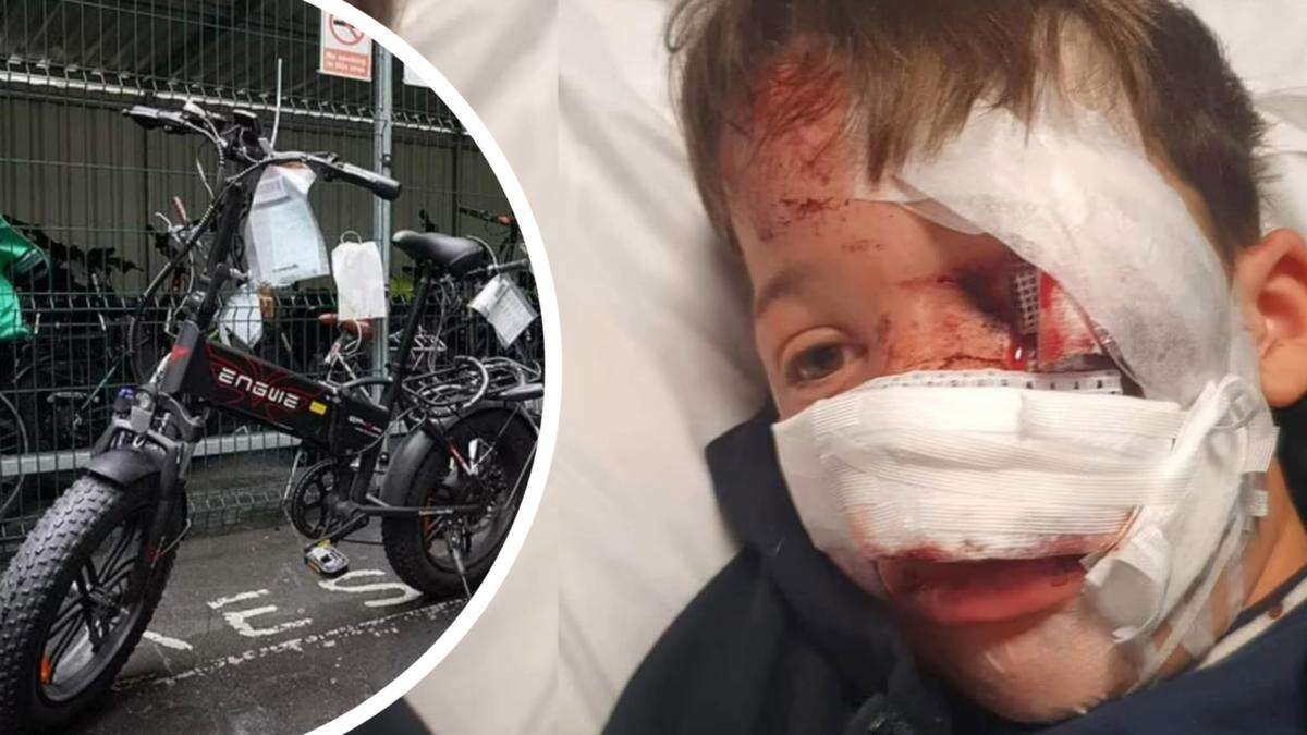 E-bike rider hit and run leaves boy with nose hanging off