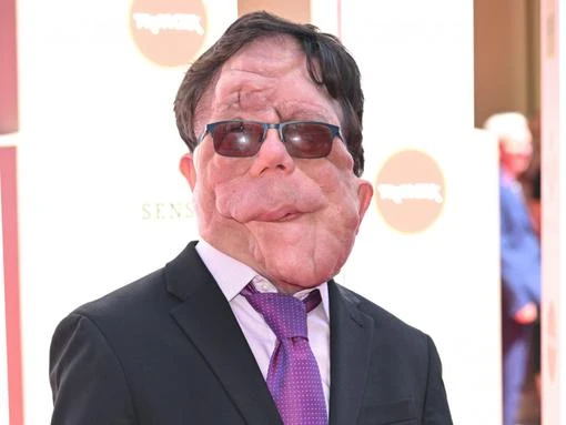 Adam Pearson 'beyond honoured' to star in Elephant Man remake