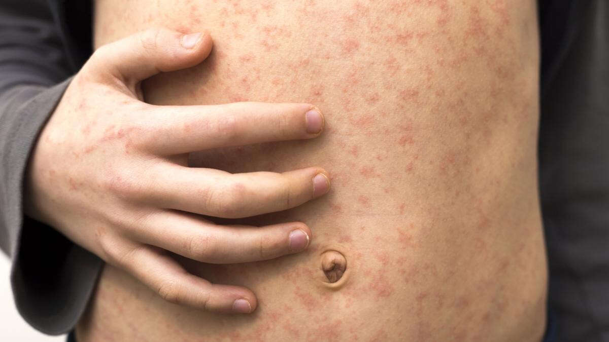 WA Health issues measles alert, lists exposure sites