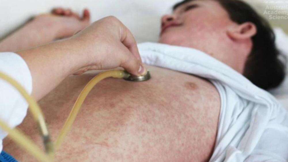 Urgent measles warning for major city