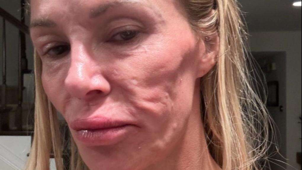 Brandi Glanville hasn't had sex in more than a year due to facial disfigurement