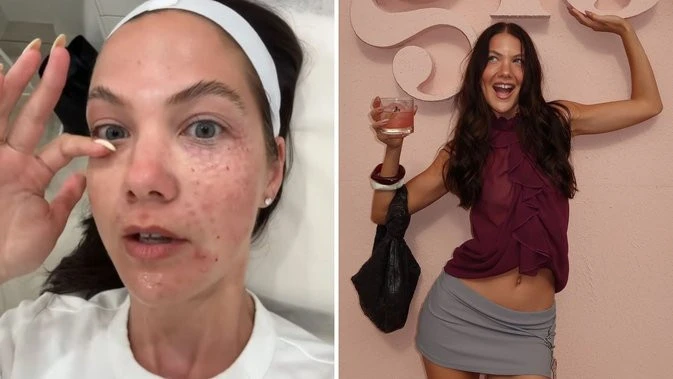 Perth influencer documents PAINFUL salmon sperm facial