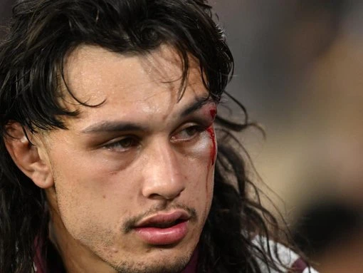 Titans sweat on Tino after nasty eye injury