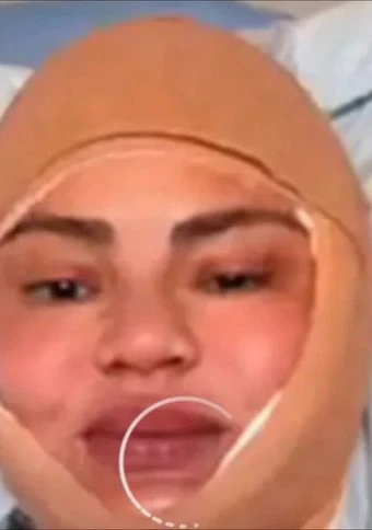 Chrissy Teigen undergoes 'hairline lowering procedure'