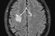 Complications neurologiques du monkeypox : deux cas documentés d’infection du cerveau et de la moelle épinière
