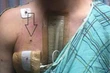 Quand le projectile d’une arme à feu voyage du point d’impact jusqu’au cerveau ou dans le cœur