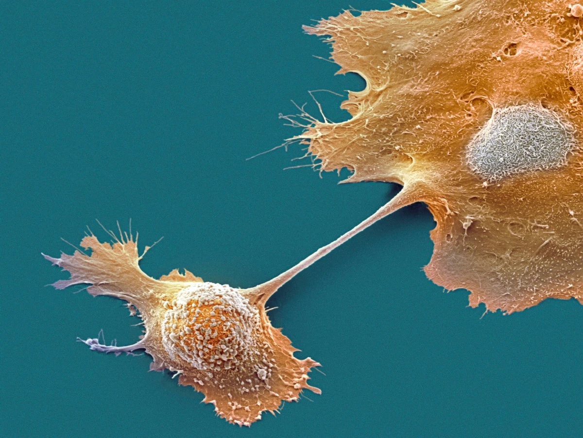 Landmark pancreatic cancer treatment paves way for targeting other tricky tumors