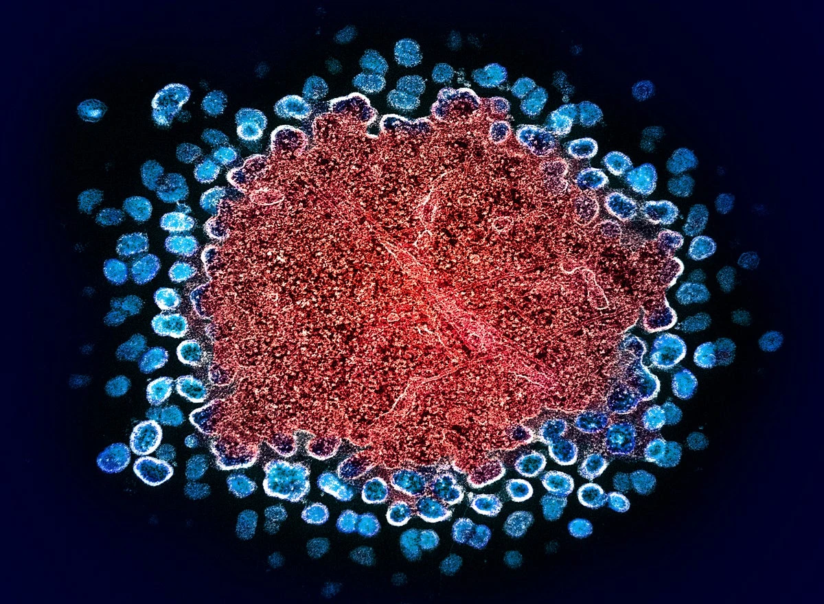 Person functionally cured of HIV after bone marrow transplant from sibling