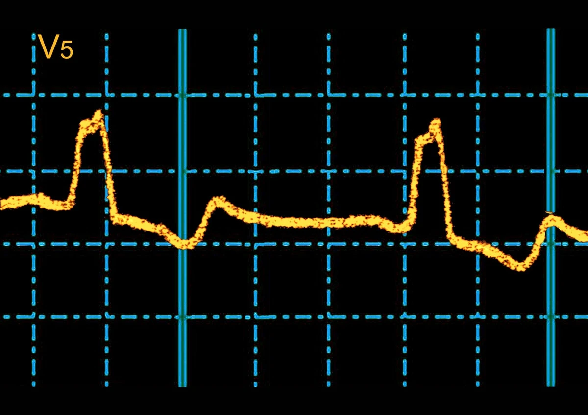 AI finds hidden ECG signal that predicts sudden cardiac death risk