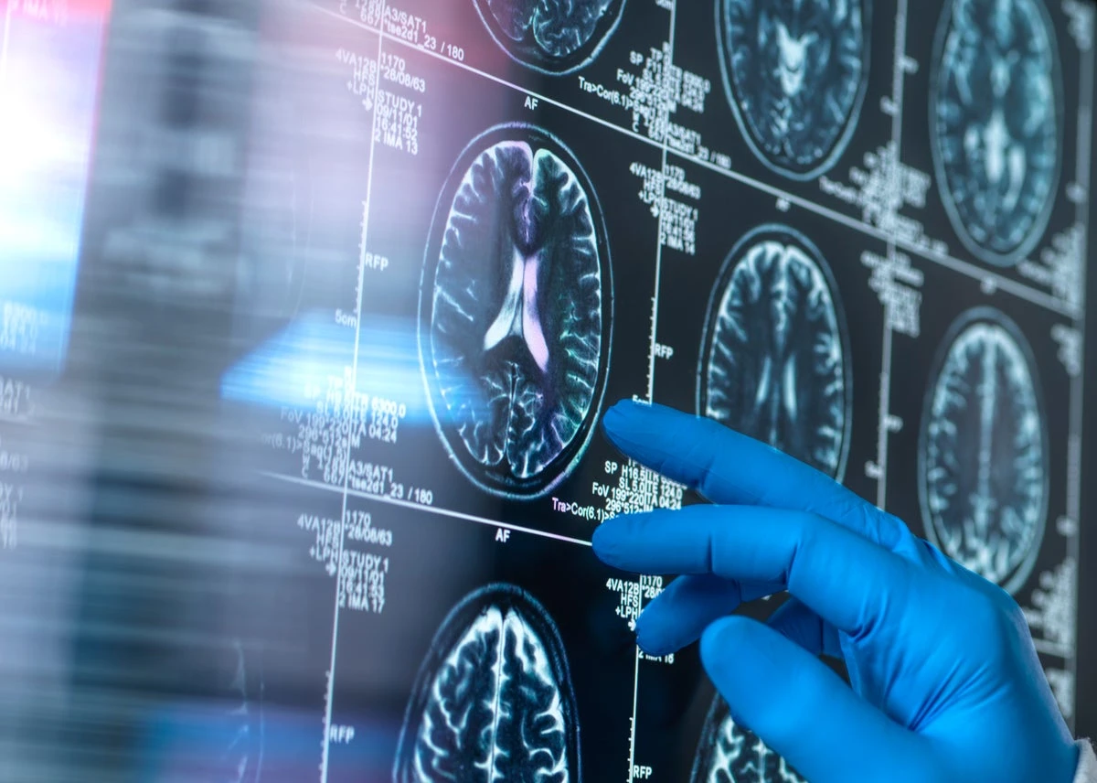 Effect of antiamyloid Alzheimer’s drugs ‘absent or trivial,’ Cochrane review finds