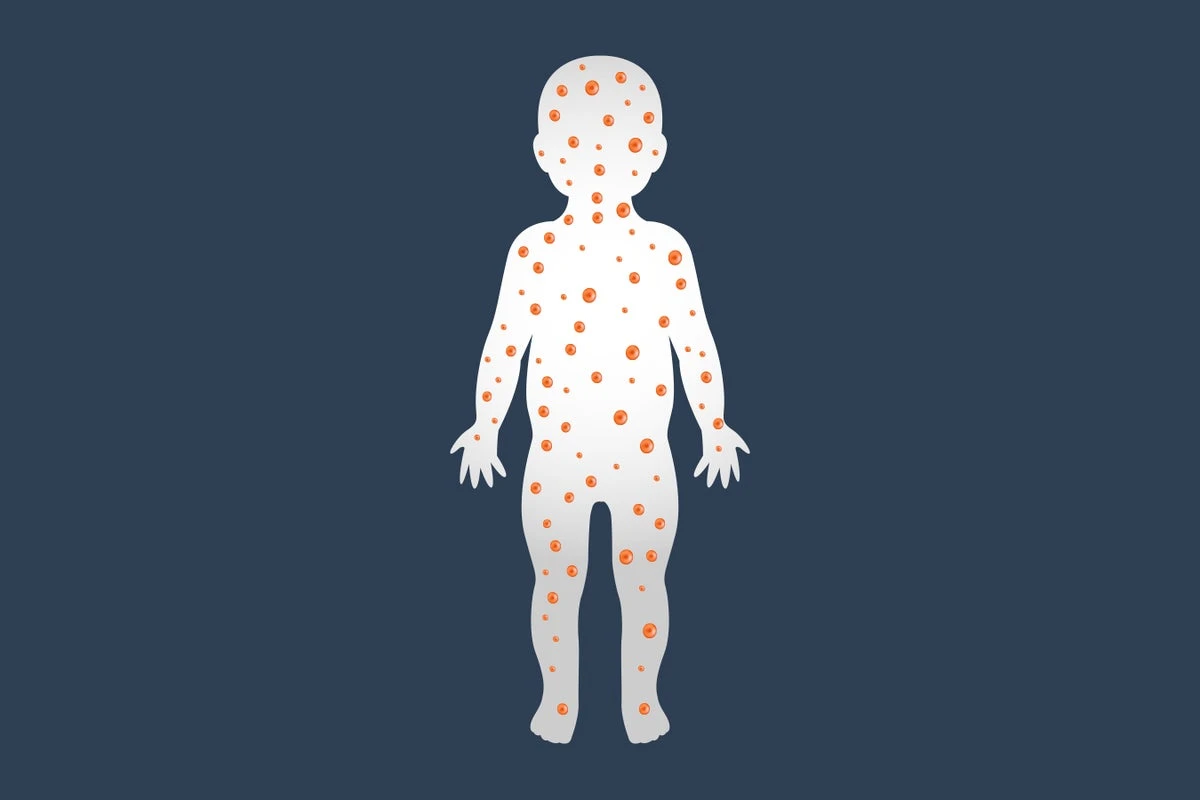 An Alarming Rise in Measles Cases Is Being Driven By Low Vaccination Rates