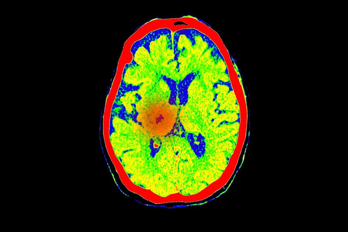 1 in 4 Unresponsive People with Brain Injuries May Be Conscious