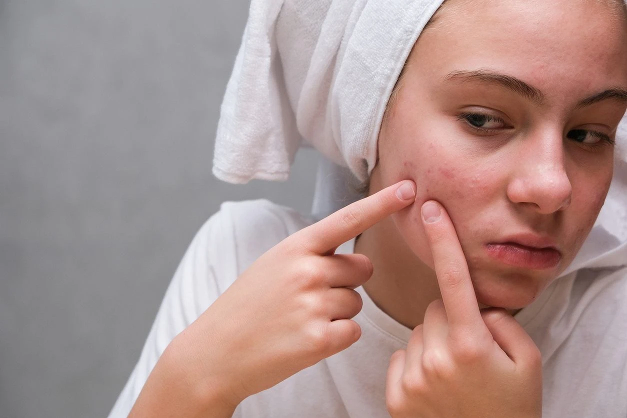 Rozpraw się z pryszczem w jedną noc. Wymieszaj z miodem i nałóż na twarz. Wyciągnie syfa jak odkurzacz