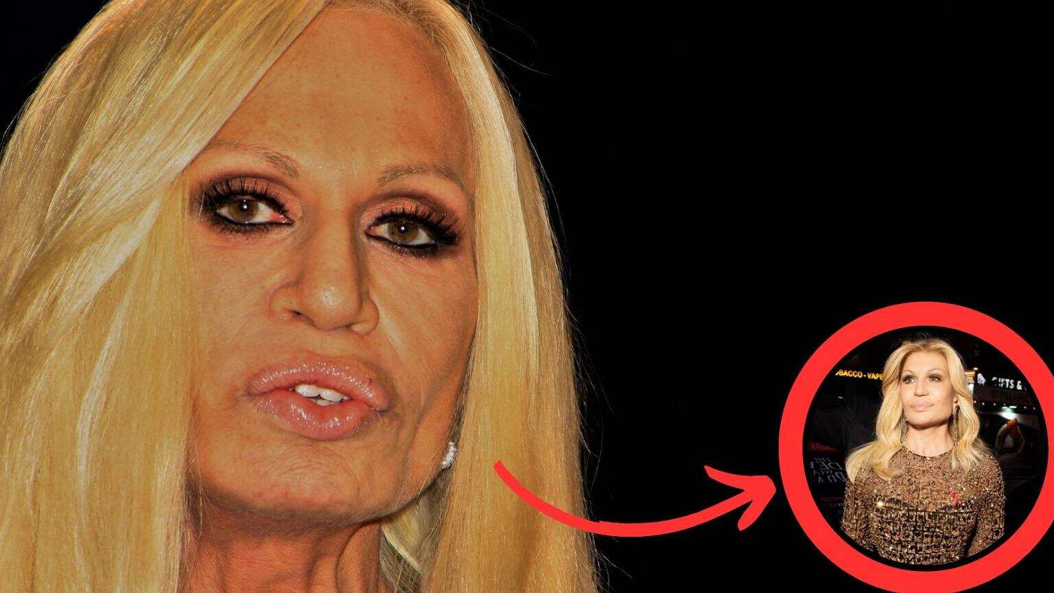 Najpierw Lindsay Lohan, teraz Donatella Versace. Za ich nowym wyglądem ma stać tajemniczy zabieg