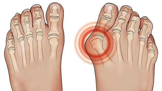 Ciri-Ciri Asam Urat di Kaki, Perubahan Warna Kulit hingga Terjadi Pembengkakan