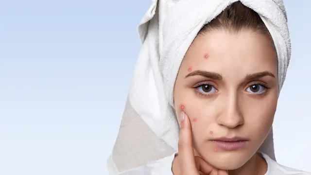 Kenali Penyebab Jerawat dari Posisinya, Mulai dari Dagu hingga Pipi