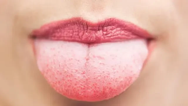 Lidah Putih Tanda Apa? Kenali Arti Warna, Penyebab dan Cara Mengatasinya