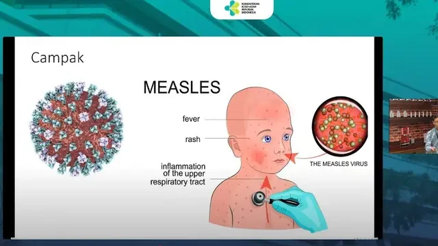 Wabah Campak di Sumenep, Mengenal Virus Penyebabnya yang Sangat Menular