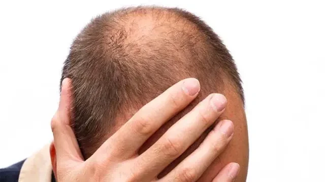 Bahan-Bahan Alami yang Cocok untuk Menebalkan Rambut, Gunakan untuk Mencegah Kebotakan