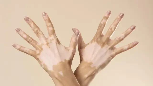Cara Baru Atasi Bercak Vitiligo, Teknologi Fototerapi Bantu Tingkatkan Rasa Percaya Diri P...