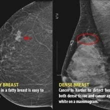 Advocates want more cancer screening for those in N.S. with dense breasts