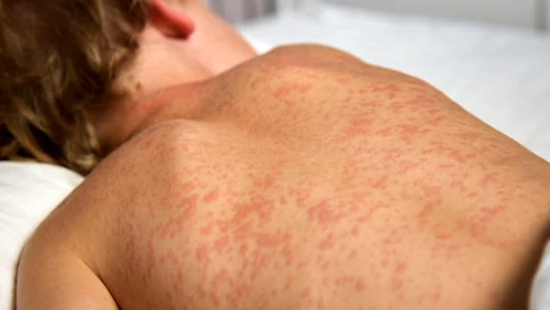Measles outbreak: Ontario sees over 220 new cases in a week