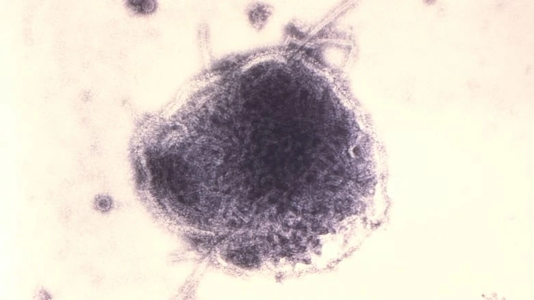 Ottawa has its 1st confirmed measles cases of the decade