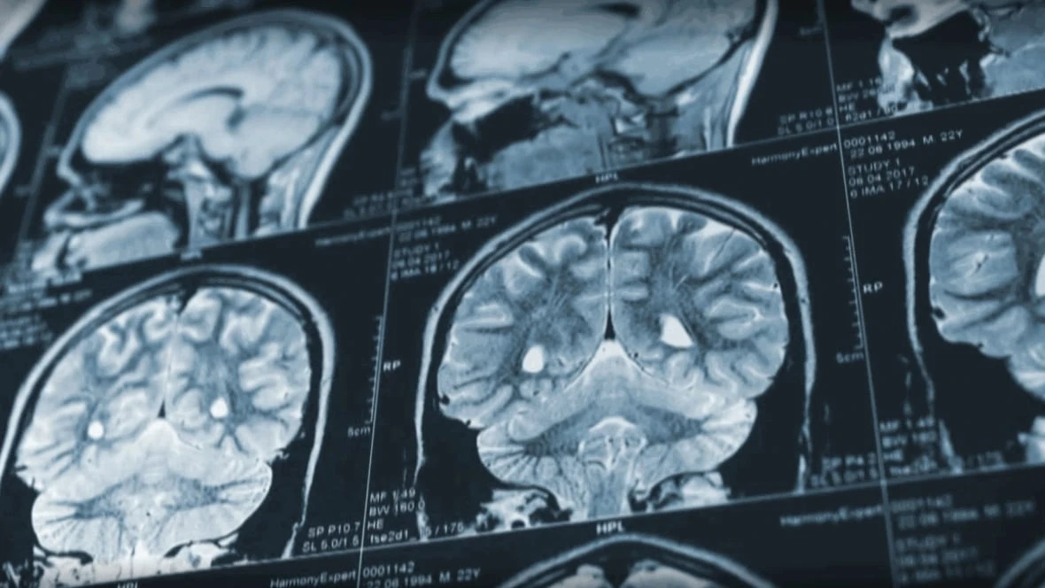 Patient advocate calls for retraction of mystery brain disease report from U.S. medical journal