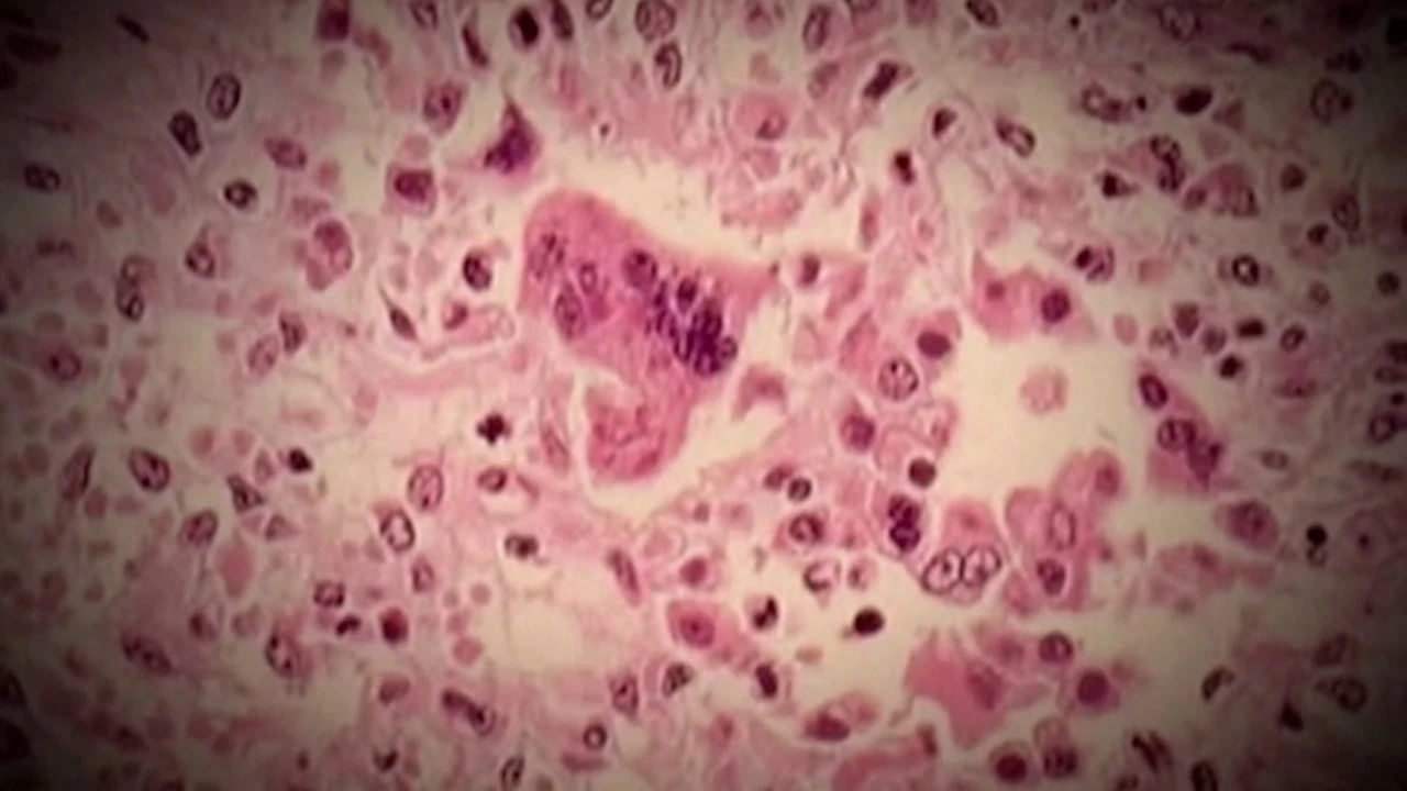 Peel Public Health investigating measles exposure on June 13