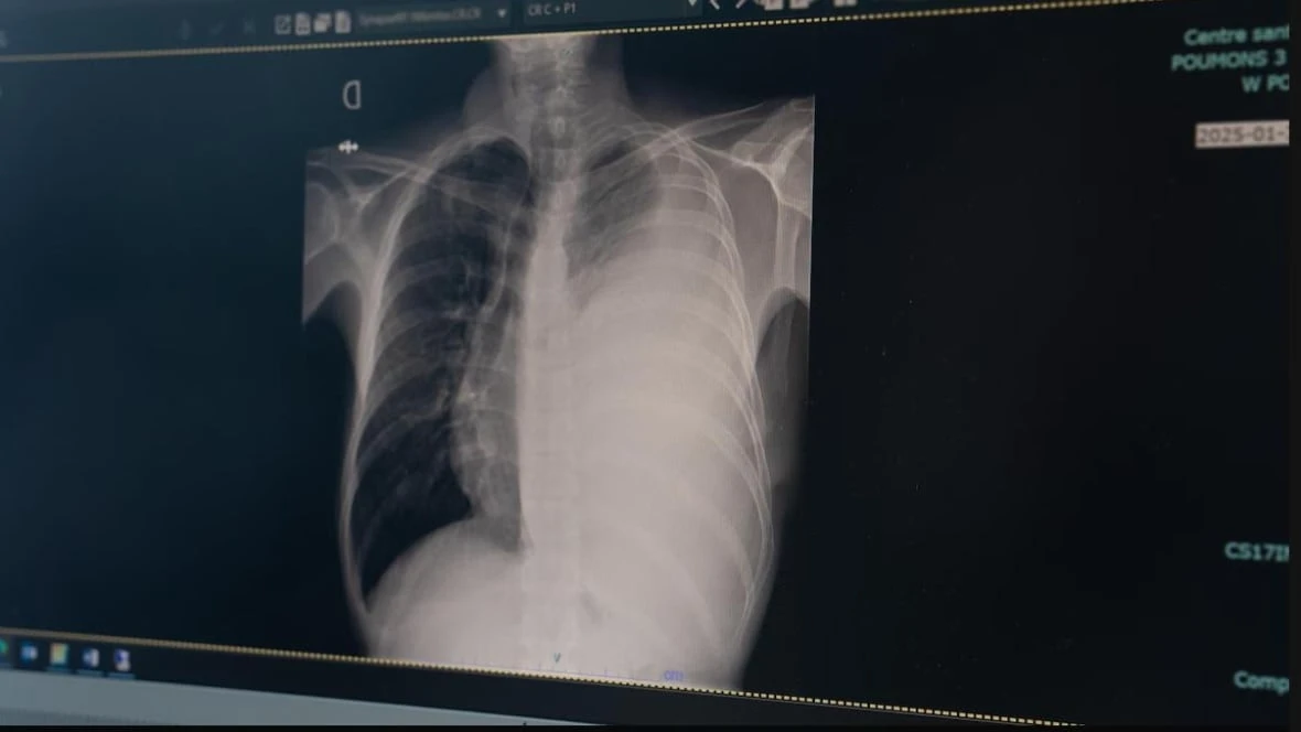 Nunavik tuberculosis action plan to be finalized in coming weeks, says health ministry
