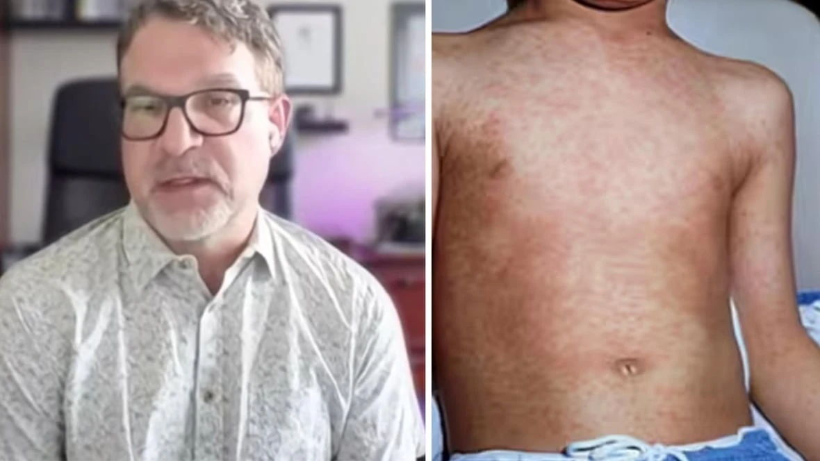 Measles spread 'like wildfire' among unvaccinated children in northeast B.C., health officer says