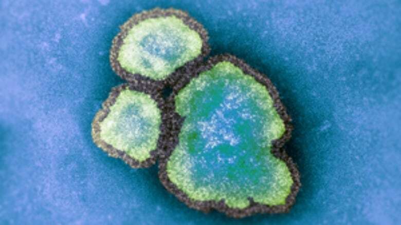 2nd case of measles related to Air Canada flight last week confirmed in B.C.'s Lower Mainland