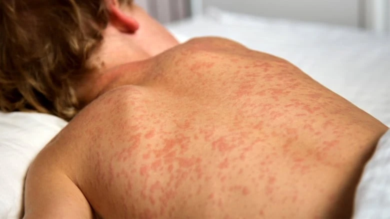 Measles jumps by 65 cases in Elgin and Oxford Counties, totalling above 1,200 across Ontario