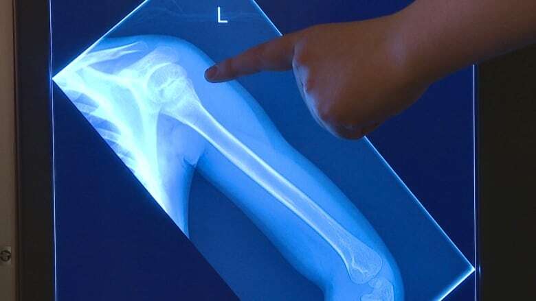 Certified physiotherapists can now order X-rays on P.E.I.