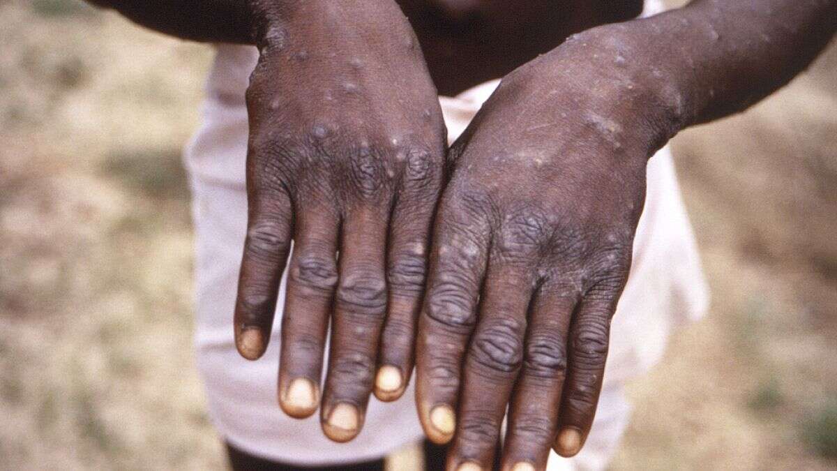 Qu'est-ce que le mpox et comment la maladie se propage-t-elle ?