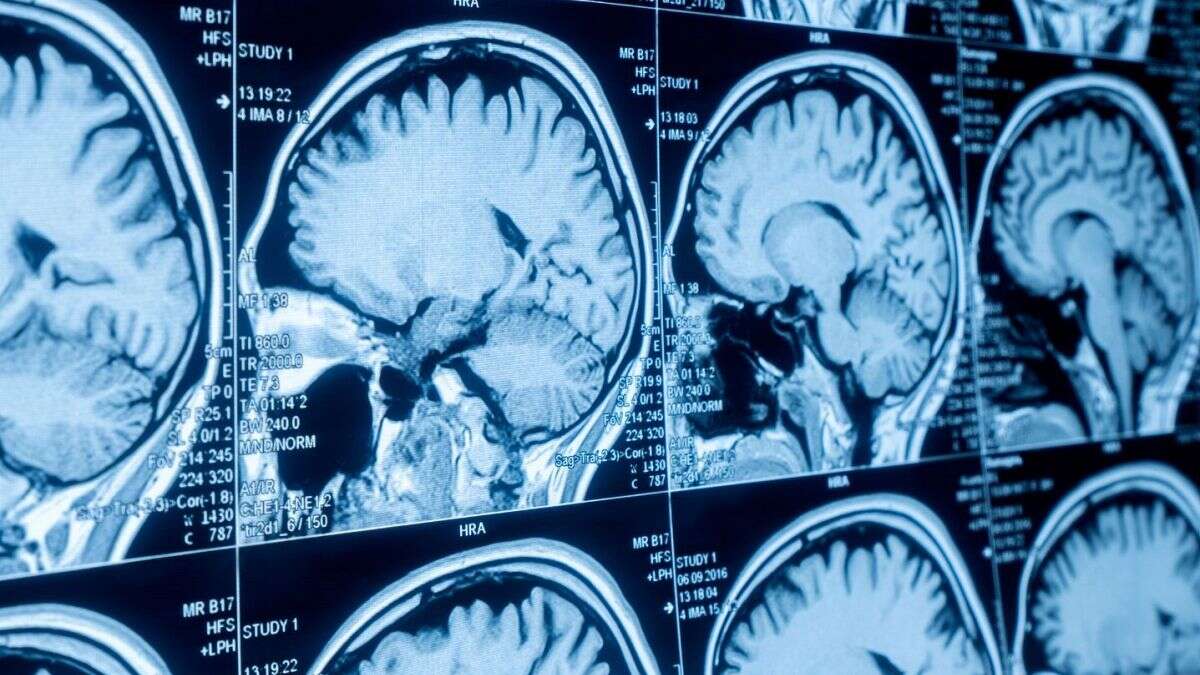 Un antidepresivo podría ayudar a tratar tumores cerebrales agresivos