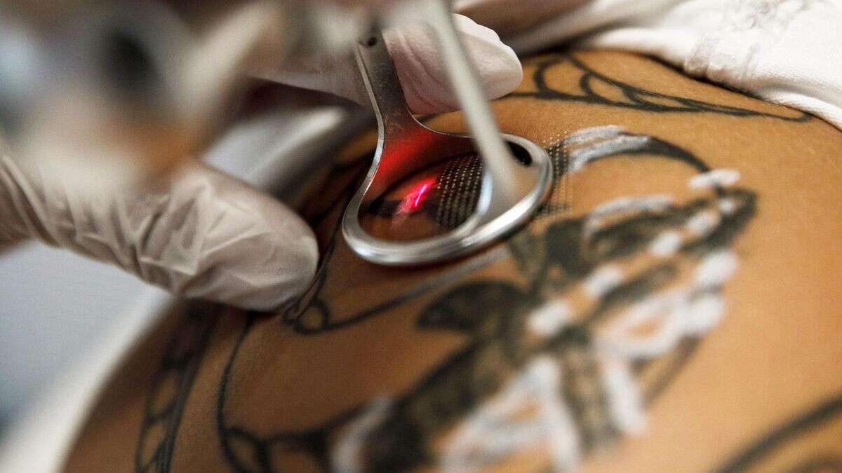 Tattoo entfernen: Experte warnt vor falscher Behandlung