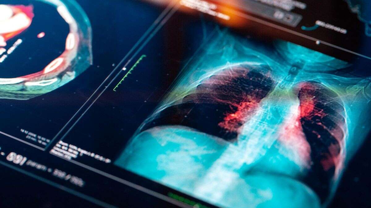 Krebs-Screening für Raucher zugelassen – zahlt die Kasse?