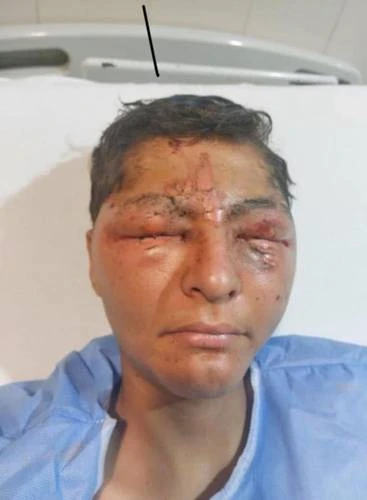 Joven pierde la vista debido a un proyecto escolar sin supervisar   