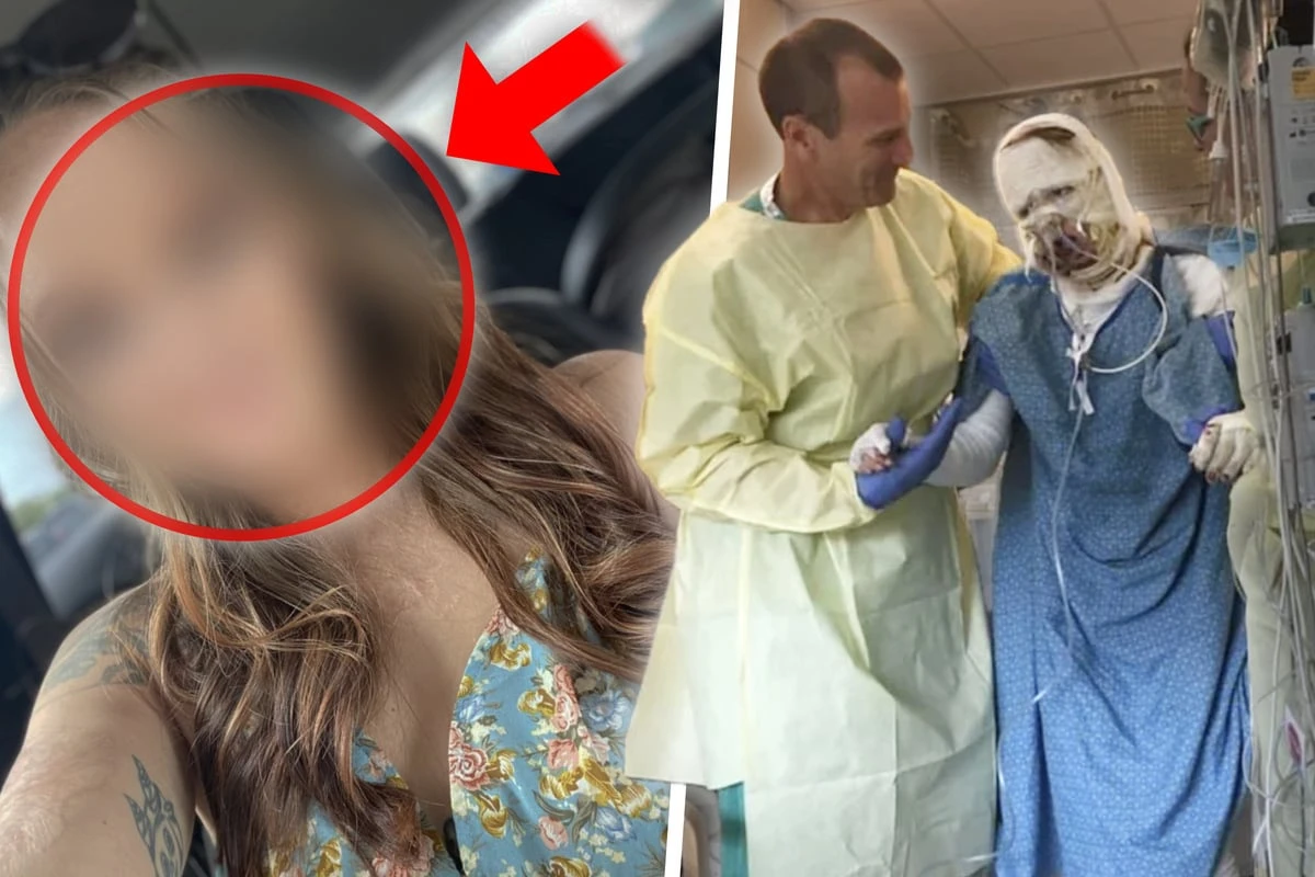 Vom Flammeninferno entstellt: Junge Frau enthüllt ihr Gesicht
