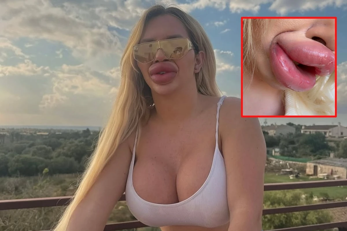 Jede Woche Lippen aufspritzen? So viel kostet Viennas Schmollmund-Rekord