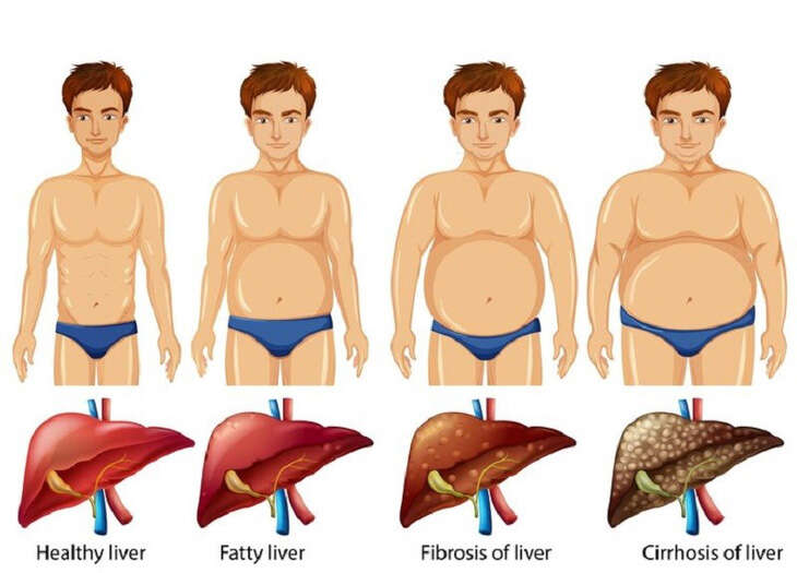 Chỉnh men gan cao theo cách tự nhiên tại nhà không dùng thuốc