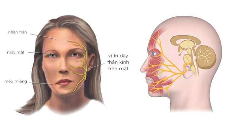 Thời tiết miền Bắc chuyển lạnh, coi chừng liệt dây thần kinh số 7