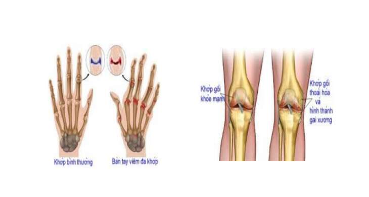 Bấm huyệt ở tay phòng trị được viêm khớp dạng thấp