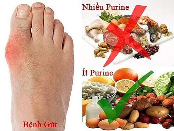 Mắc bệnh gout có cần kiêng hoàn toàn đạm?