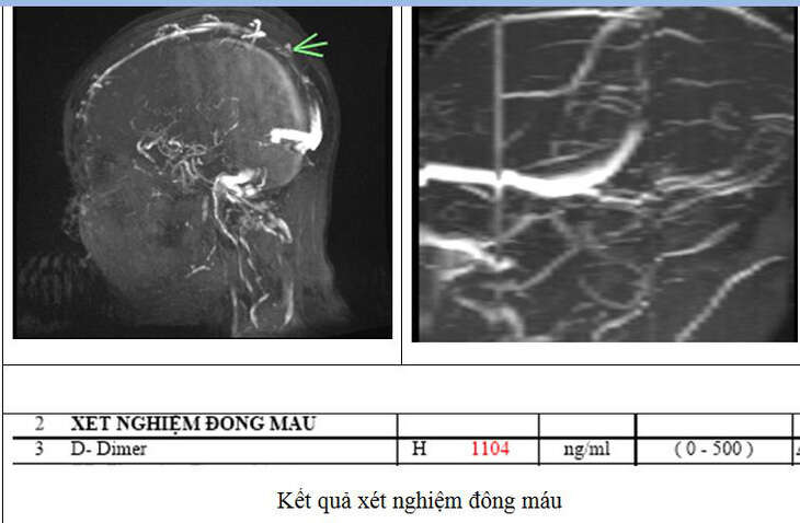 Đau đầu 4 ngày, đến viện mới phát hiện mắc thể đột quỵ não đặc biệt