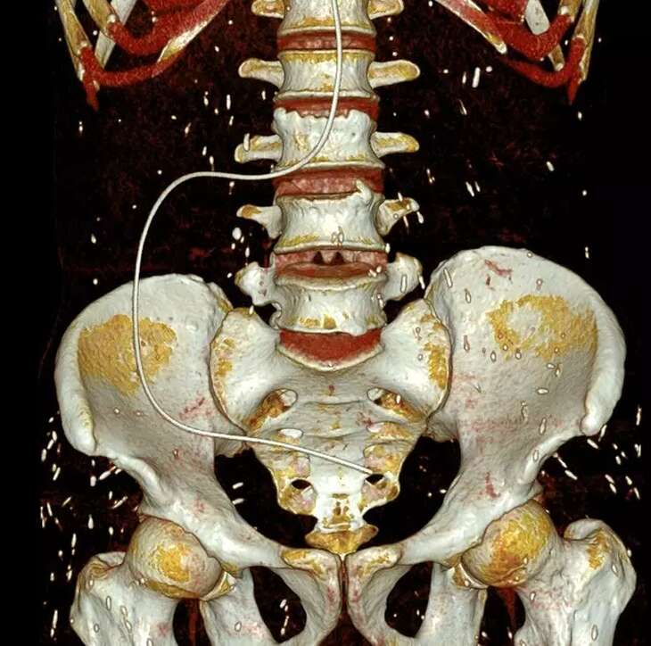 Chụp CT, tá hỏa phát hiện sán rải rác khắp cơ thể người bệnh